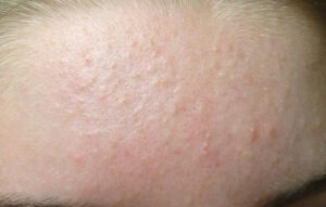Cách trị mụn ẩn dưới da tại nhà: Cách đánh thức làn da mịn màng