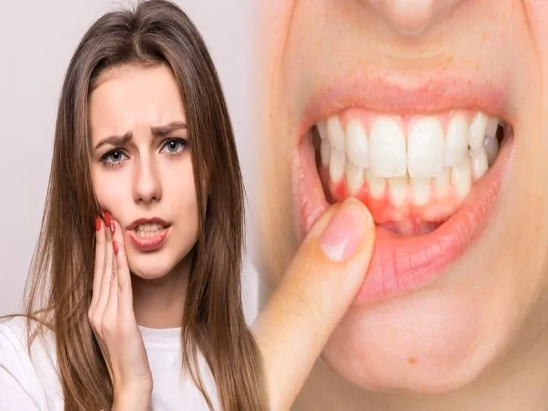 Chảy máu chân răng do đâu? – Nguyên nhân, dấu hiệu và cách khắc phục